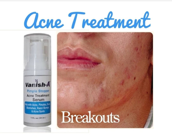 Vanish-A Bump Stopper Acne Serum 1 .oz - Good Brands USA